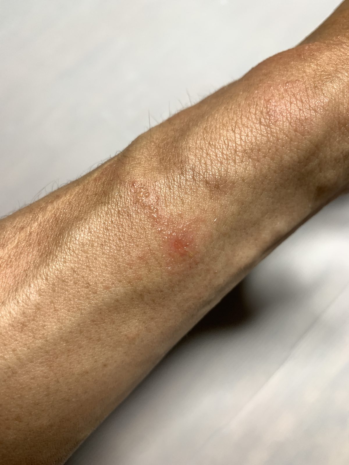 ハゼノキ伐採後、前腕に出たかぶれ。水疱と発赤がみられる。